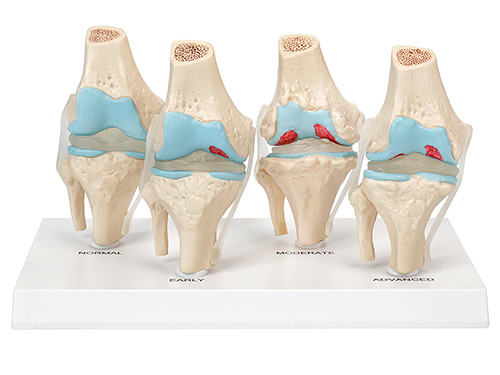 膝關節健康病態比較模型