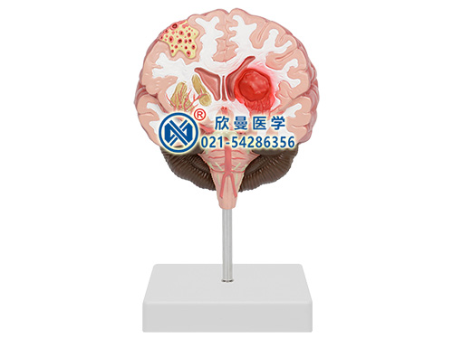 腦中風模型(大腦疾病模型)