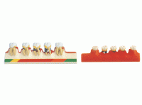 牙周病模型 牙周病分類(lèi)模型